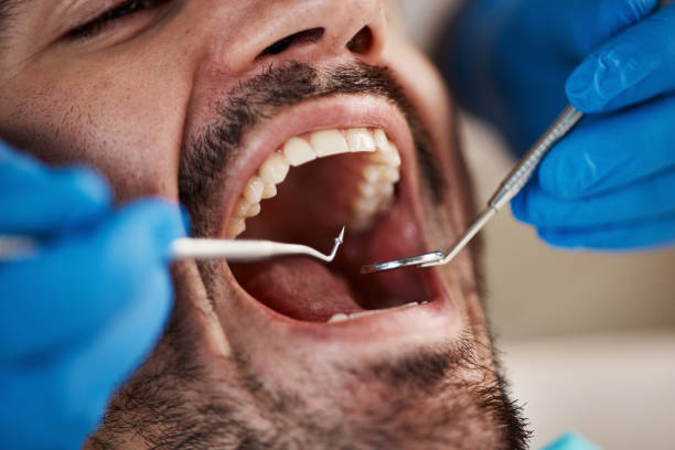 Best Emergency Wisdom Tooth Extraction in Camp Point, IL